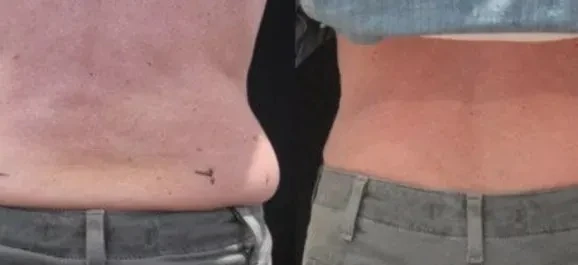 Före och efter fettfrysning, flankerna bakifrån. Före till vänster, efter till höger