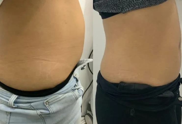 Före och efter fettfrysning, magen från sidan. Före till vänster, efter till höger